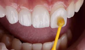 Veneers & Laminates
